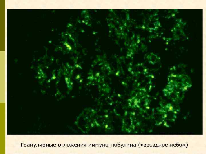 Гранулярные отложения иммуноглобулина ( «звездное небо» ) 