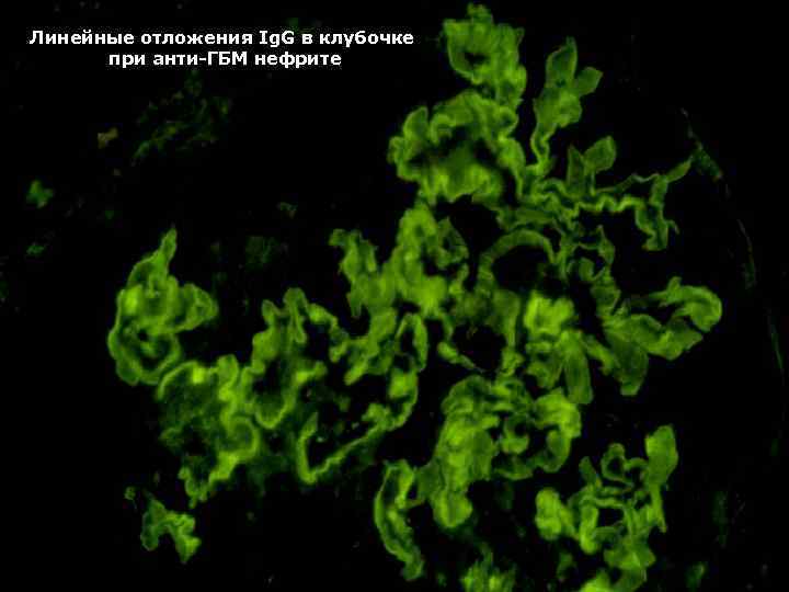Линейные отложения Ig. G в клубочке при анти-ГБМ нефрите 