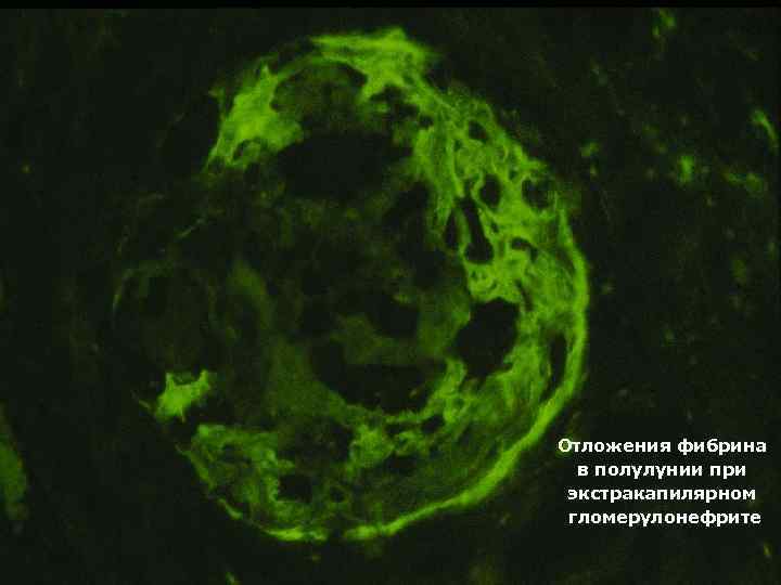 Отложения фибрина в полулунии при экстракапилярном гломерулонефрите 