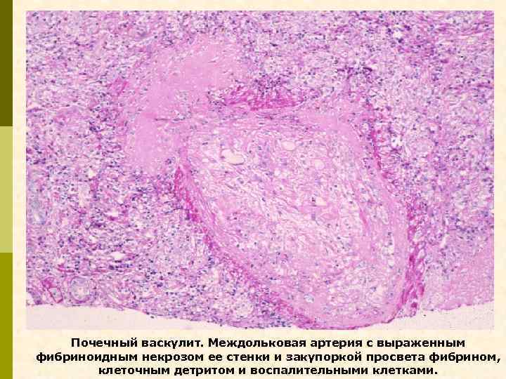 Почечный васкулит. Междольковая артерия с выраженным фибриноидным некрозом ее стенки и закупоркой просвета фибрином,