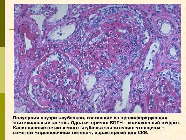 Полулуния внутри клубочков, состоящие из пролиферирующих эпителиальных клеток. Одна из причин БПГН - волчаночный