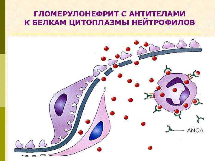 ГЛОМЕРУЛОНЕФРИТ С АНТИТЕЛАМИ К БЕЛКАМ ЦИТОПЛАЗМЫ НЕЙТРОФИЛОВ 