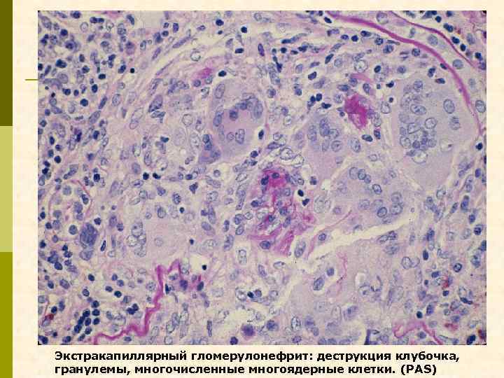 Экстракапиллярный гломерулонефрит: деструкция клубочка, гранулемы, многочисленные многоядерные клетки. (PAS) 