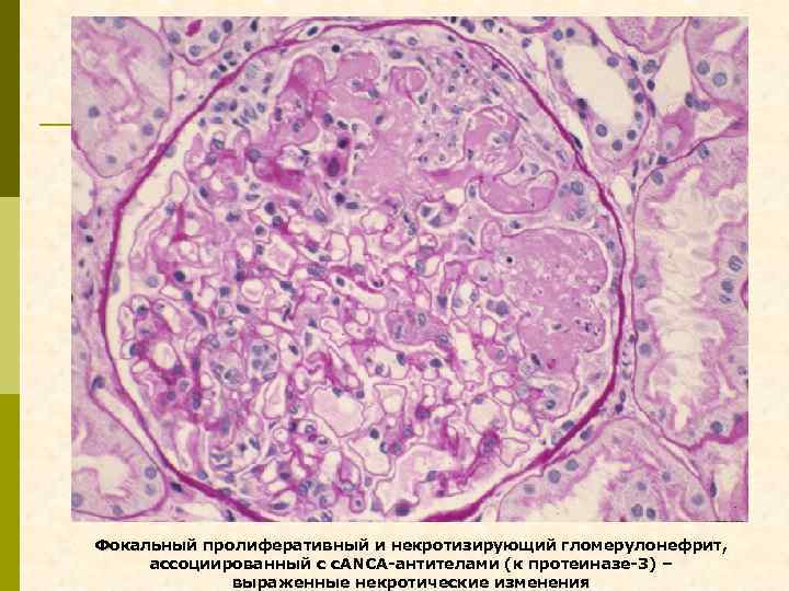 Фокальный пролиферативный и некротизирующий гломерулонефрит, ассоциированный с с. ANCA-антителами (к протеиназе-3) – выраженные некротические