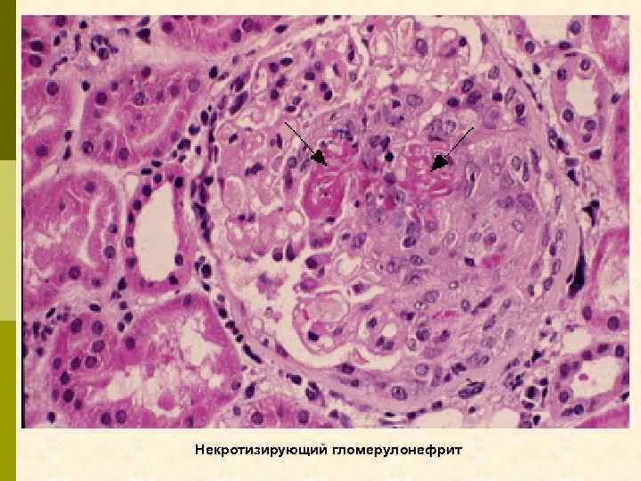 Некротизирующий гломерулонефрит 