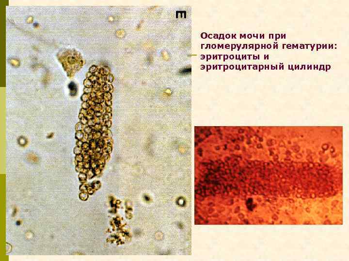 Осадок мочи при гломерулярной гематурии: эритроциты и эритроцитарный цилиндр 