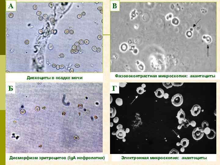 А В Дискоциты в осадке мочи Б Дисморфизм эритроцитов (Ig. А нефропатия) Фазовоконтрастная микроскопия: