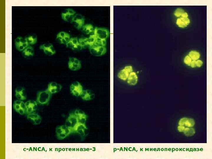 с-ANCA, к протеиназе-3 р-ANCA, к миелопероксидазе 