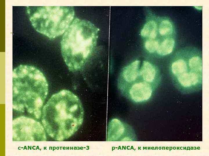 с-ANCA, к протеиназе-3 р-ANCA, к миелопероксидазе 