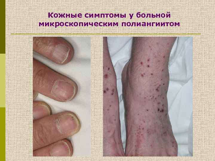 Кожные симптомы у больной микроскопическим полиангиитом 