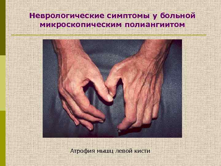 Неврологические симптомы у больной микроскопическим полиангиитом Атрофия мышц левой кисти 