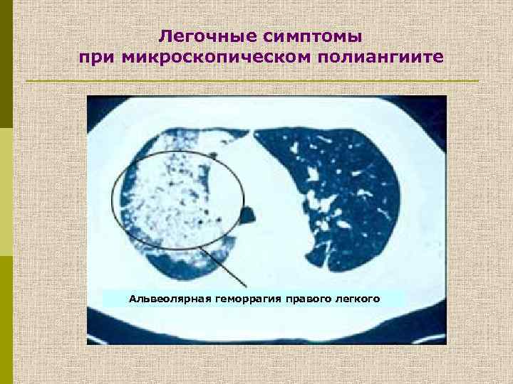 Легочные симптомы при микроскопическом полиангиите Атрофия мышц правой кисти Альвеолярная геморрагия правого легкого 