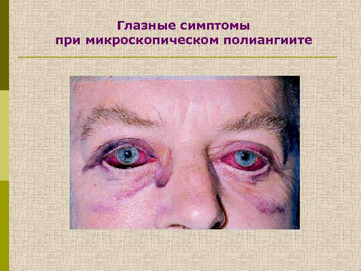 Глазные симптомы при микроскопическом полиангиите 