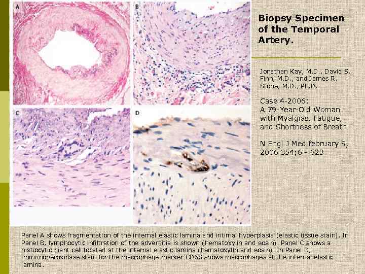 Biopsy Specimen of the Temporal Artery. Jonathan Kay, M. D. , David S. Finn,