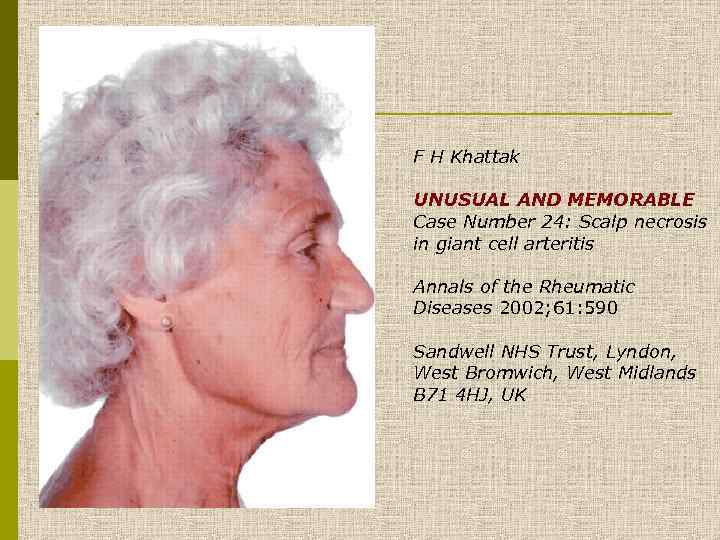 F H Khattak UNUSUAL AND MEMORABLE Case Number 24: Scalp necrosis in giant cell