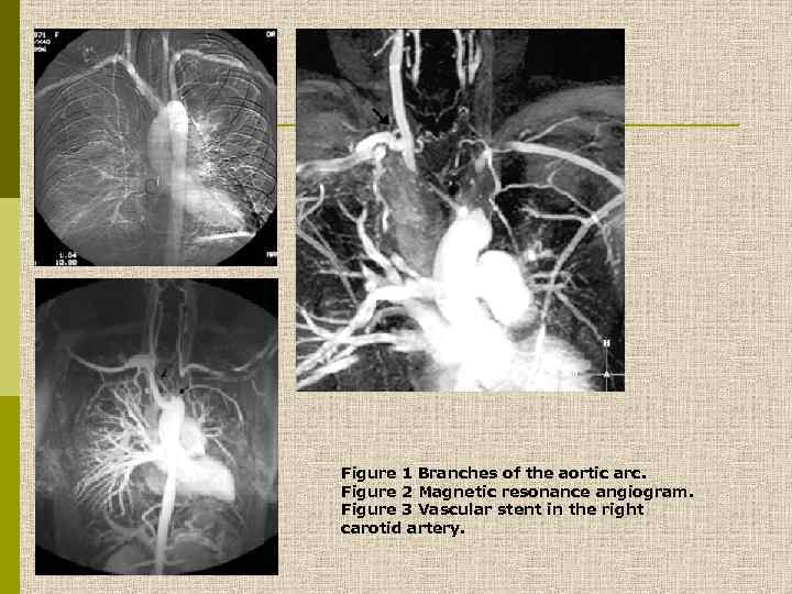 Figure 1 Branches of the aortic arc. Figure 2 Magnetic resonance angiogram. Figure 3
