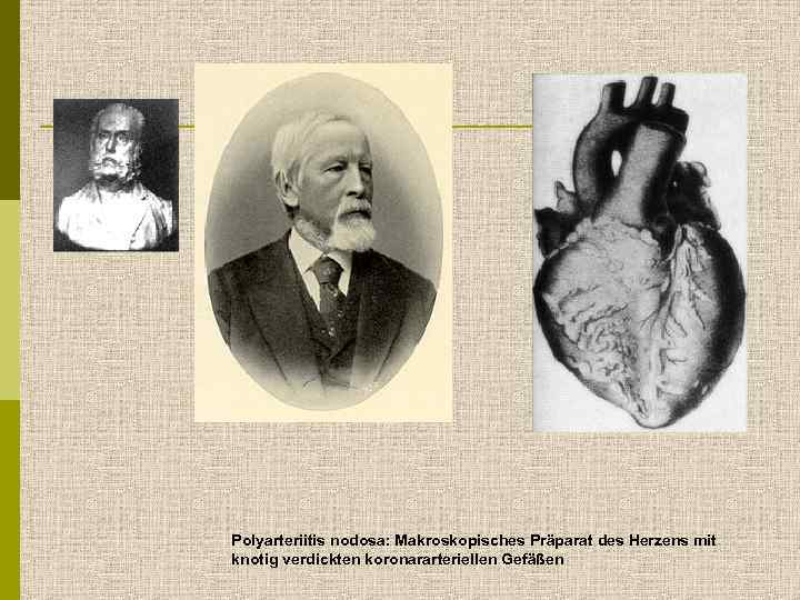 Polyarteriitis nodosa: Makroskopisches Präparat des Herzens mit knotig verdickten koronararteriellen Gefäßen 