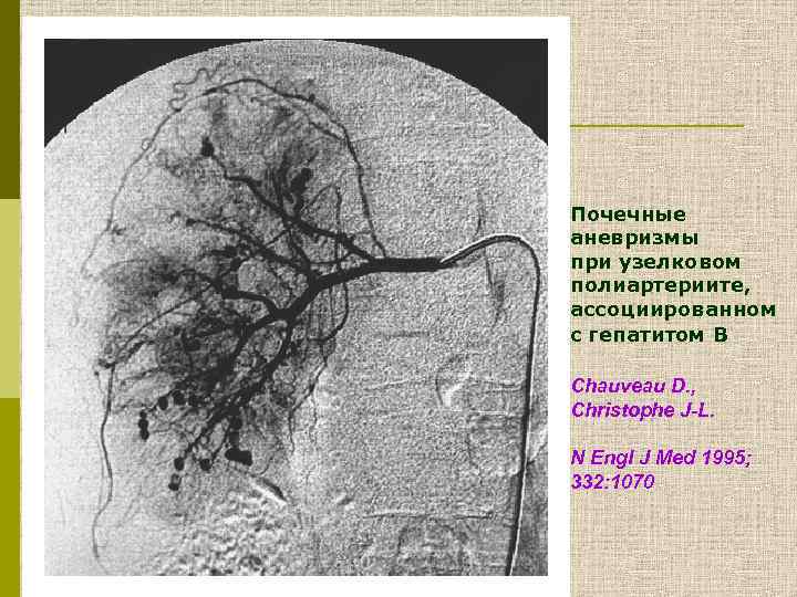 Васкулиты патанатомия презентация