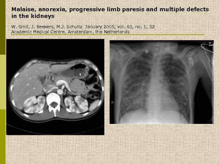 Malaise, anorexia, progressive limb paresis and multiple defects in the kidneys W. Smit, J.