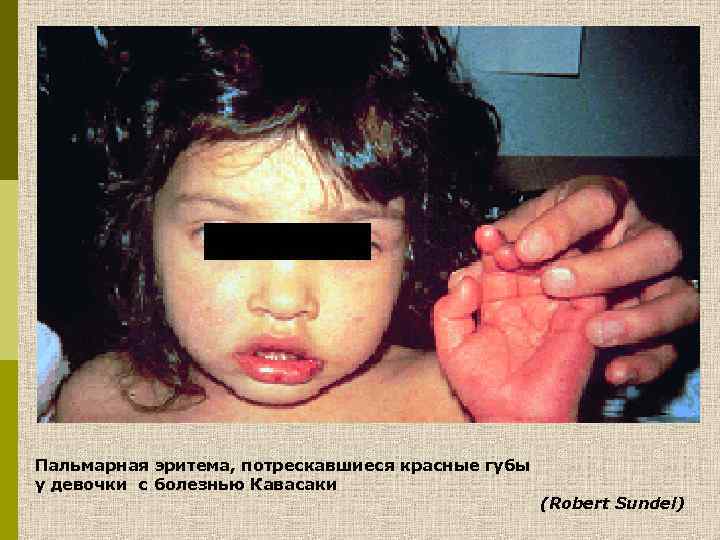 Пальмарная эритема, потрескавшиеся красные губы у девочки с болезнью Кавасаки (Robert Sundel) 