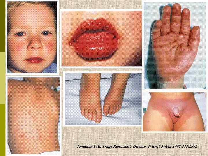 Jonathan D. K. Trage Kawasaki's Disease N Engl J Med 1995; 333: 1391 