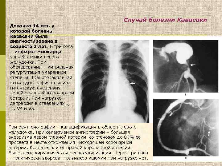 Болезнь кавасаки у детей фото