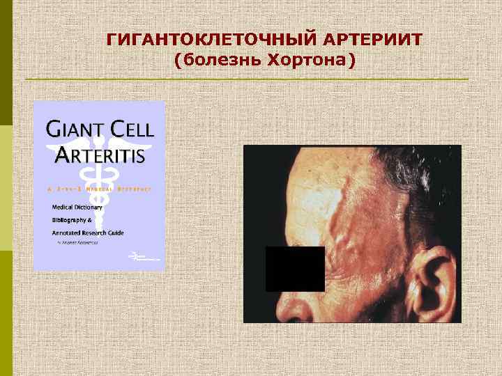 ГИГАНТОКЛЕТОЧНЫЙ АРТЕРИИТ (болезнь Хортона) 