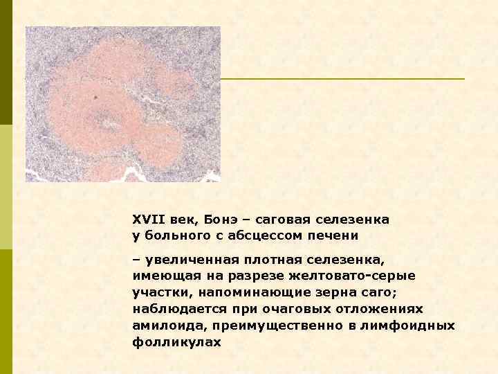 XVII век, Бонэ – саговая селезенка у больного с абсцессом печени – увеличенная плотная