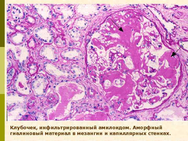 Клубочек, инфильтрированный амилоидом. Аморфный гиалиновый материал в мезангии и капиллярных стенках. 