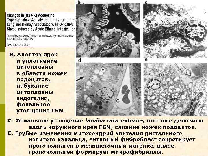 В. Апоптоз ядер и уплотнение цитоплазмы в области ножек подоцитов, набухание цитоплазмы эндотелия, фокальное