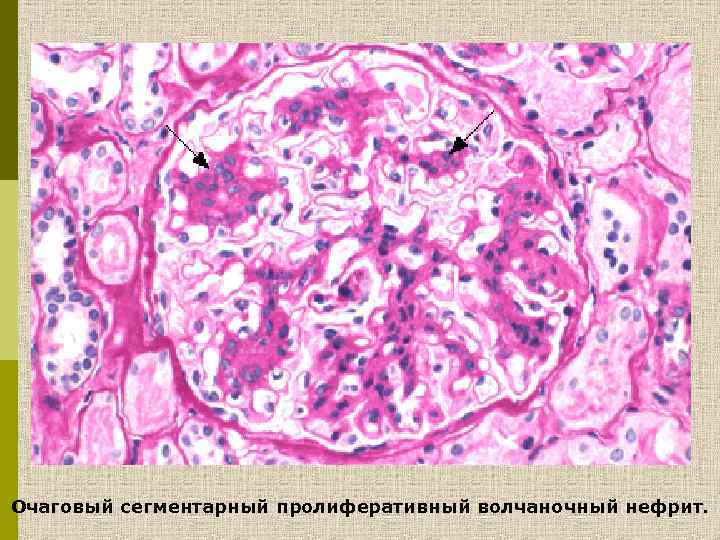 Очаговый сегментарный пролиферативный волчаночный нефрит. 