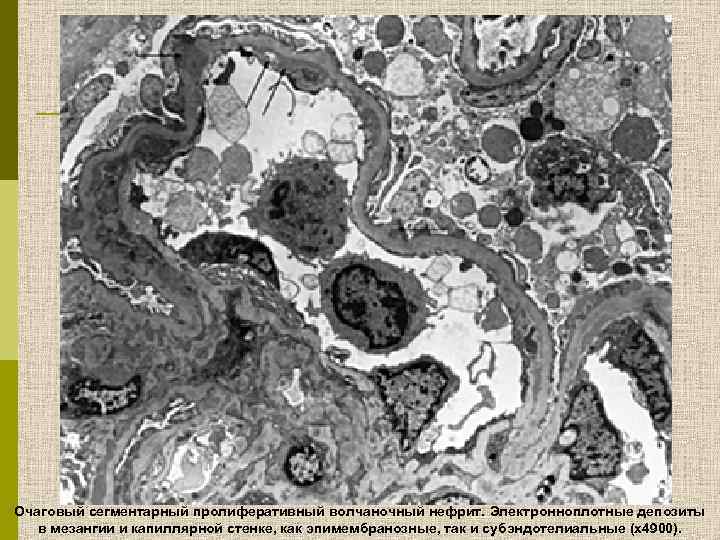 Очаговый сегментарный пролиферативный волчаночный нефрит. Электронноплотные депозиты в мезангии и капиллярной стенке, как эпимембранозные,