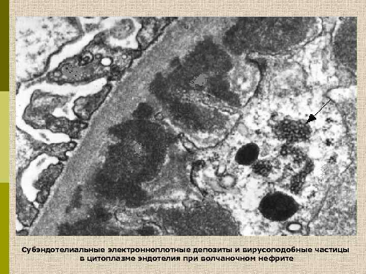 Субэндотелиальные электронноплотные депозиты и вирусоподобные частицы в цитоплазме эндотелия при волчаночном нефрите 