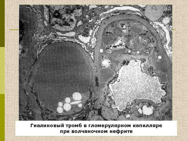 Гиалиновый тромб в гломерулярном капилляре при волчаночном нефрите 