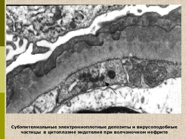 Субэпителиальные электронноплотные депозиты и вирусоподобные частицы в цитоплазме эндотелия при волчаночном нефрите 