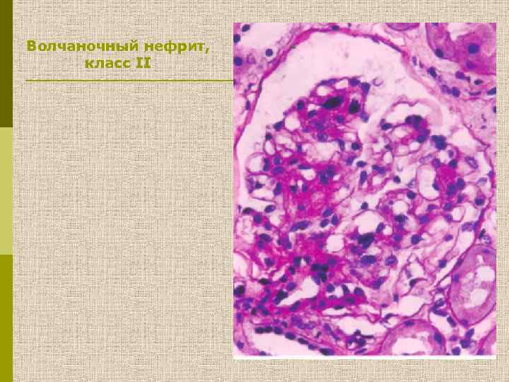 Волчаночный нефрит, класс II 