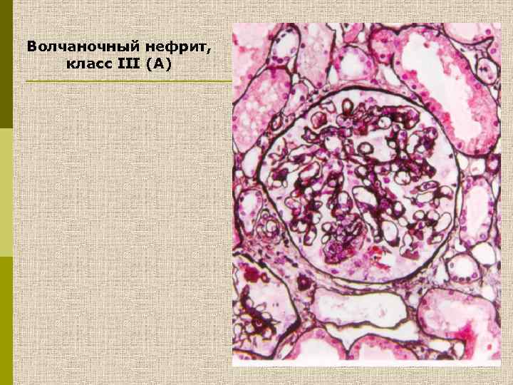 Волчаночный нефрит, класс III (A) 