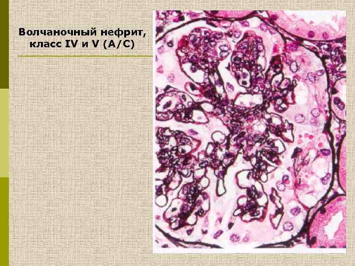 Волчаночный нефрит, класс IV и V (A/C) 