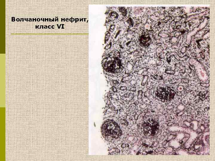 Волчаночный нефрит, класс VI 