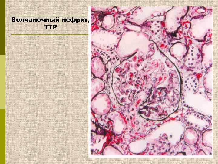 Волчаночный нефрит презентация