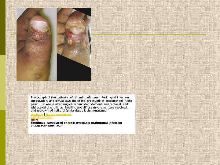 Photograph of the patient's left thumb. Left panel: Periungual infection, suppuration, and diffuse swelling