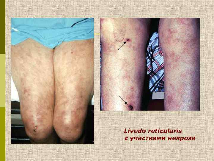 Livedo reticularis с участками некроза 