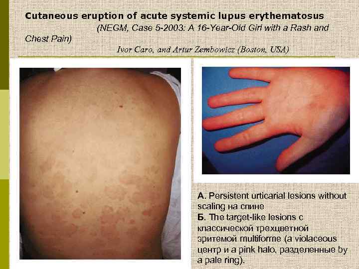 Cutaneous eruption of acute systemic lupus erythematosus (NEGM, Case 5 -2003: A 16 -Year-Old