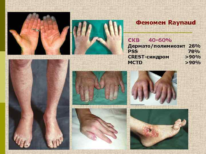 Феномен Raynaud СКВ 40 -60% Дермато/полимиозит 28% PSS 78% CREST-синдром >90% MCTD >90% 