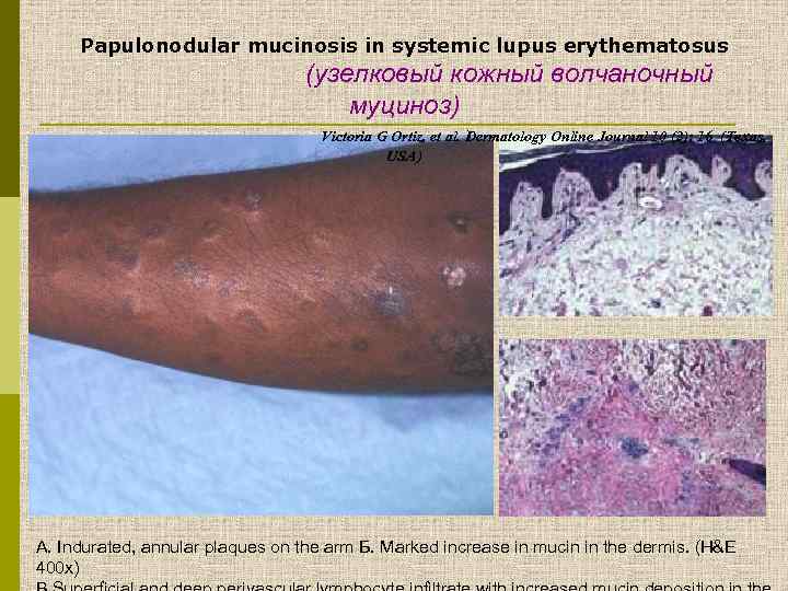 Papulonodular mucinosis in systemic lupus erythematosus (узелковый кожный волчаночный муциноз) Victoria G Ortiz, et