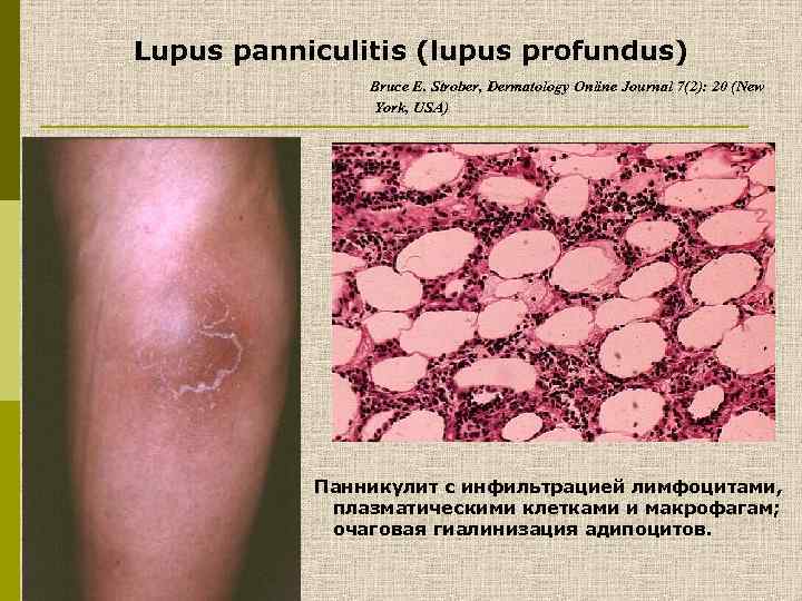 Lupus panniculitis (lupus profundus) Bruce E. Strober, Dermatology Online Journal 7(2): 20 (New York,