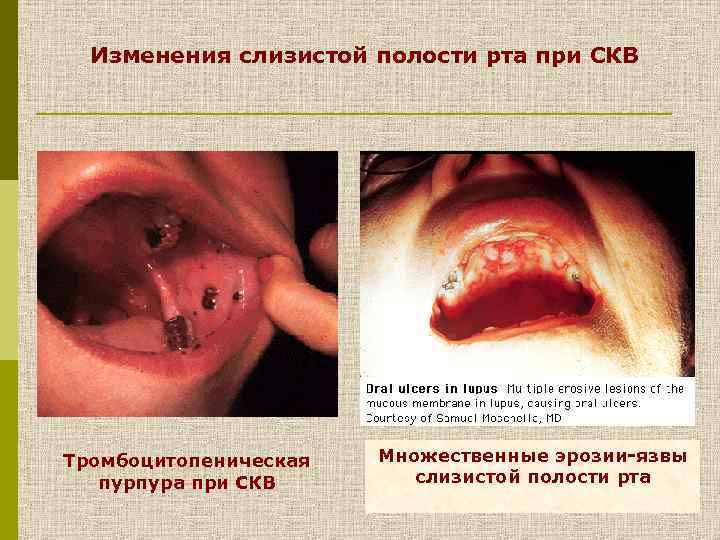 Изменения слизистой полости рта при СКВ Тромбоцитопеническая пурпура при СКВ Множественные эрозии-язвы слизистой полости