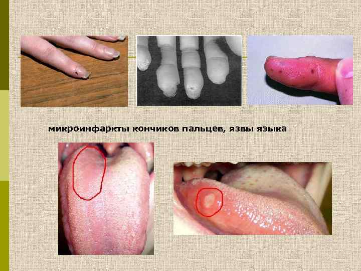 микроинфаркты кончиков пальцев, язвы языка 