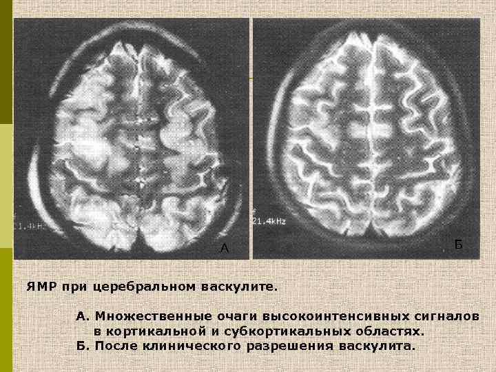 А Б ЯМР при церебральном васкулите. А. Множественные очаги высокоинтенсивных сигналов в кортикальной и