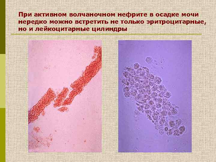 При активном волчаночном нефрите в осадке мочи нередко можно встретить не только эритроцитарные, но